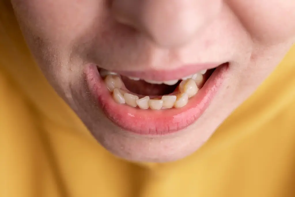 Primer plano de dientes apiñados