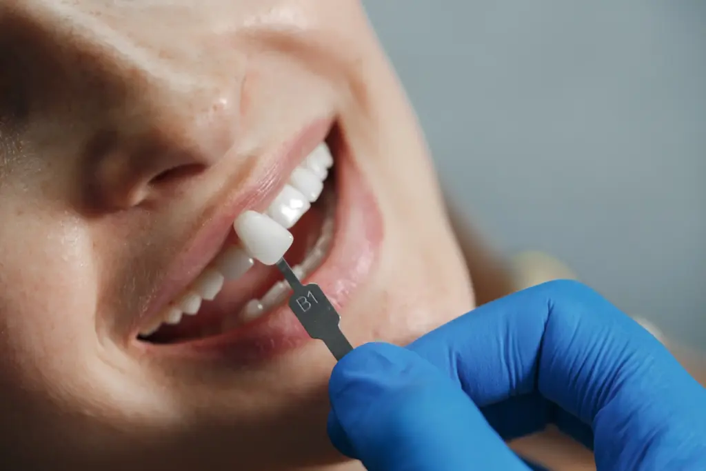 Dentista comparando el tono de una carilla dental con los dientes de una paciente