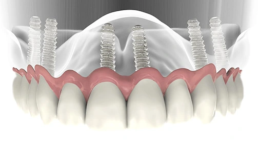 Implantes