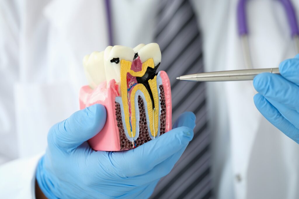 doctor señalando maqueta de diente diente dañado por dentrol