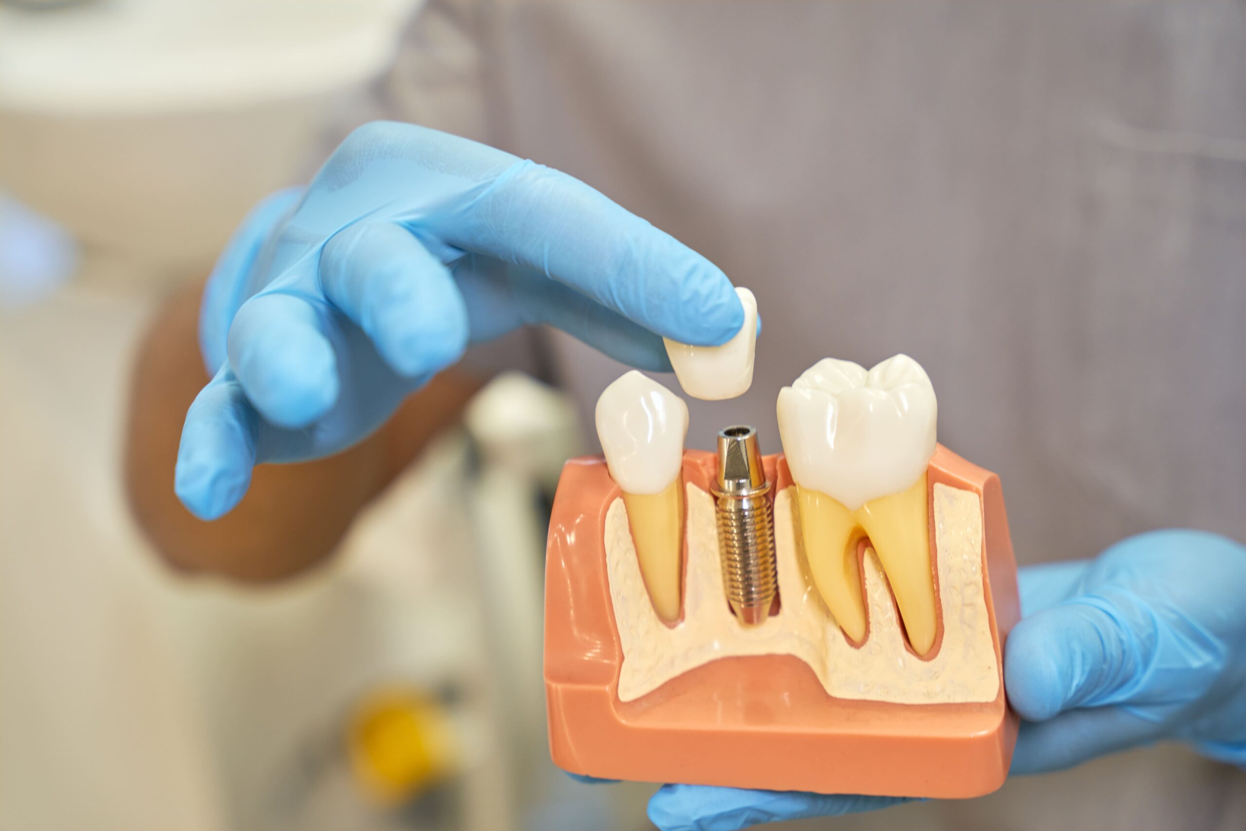 dentista enseñando maqueta de implantes dentales en los que coloca una corona dental